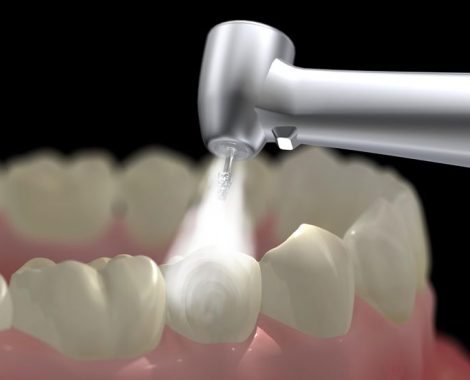 715ee81a69822aa046b088357fb2c015--dental-fillings-dental-services