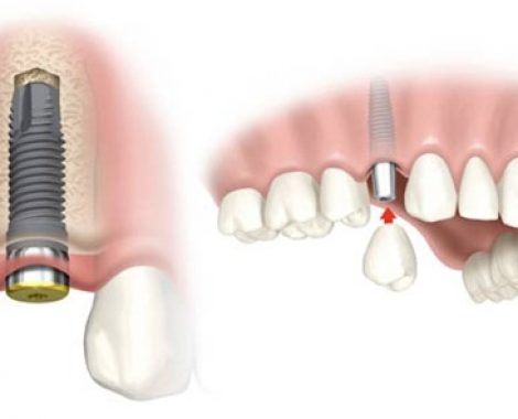 Implant-Pic