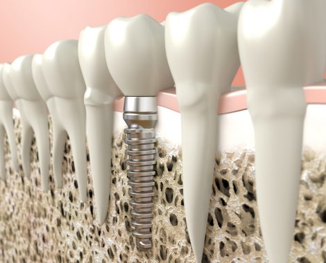 Dental implant